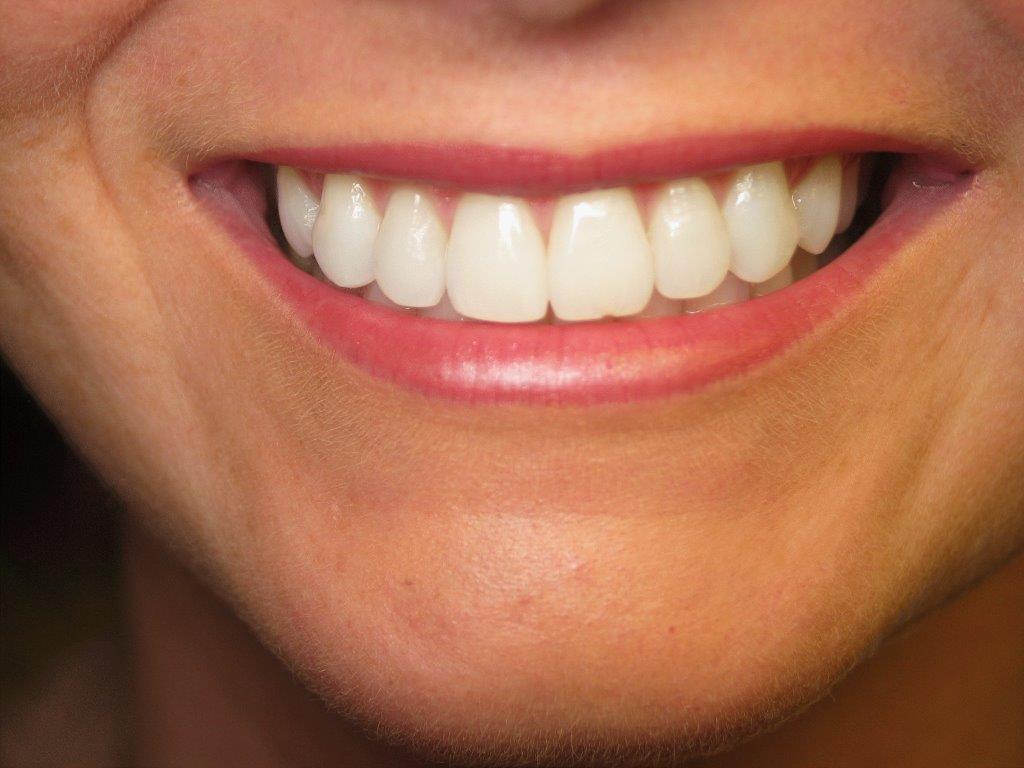 Teeth Whitening Jonesboro AR After Photos