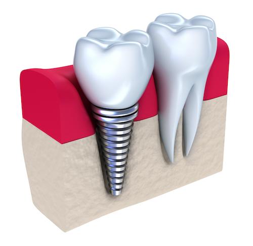 Dental implant diagram | Jonesboro AR