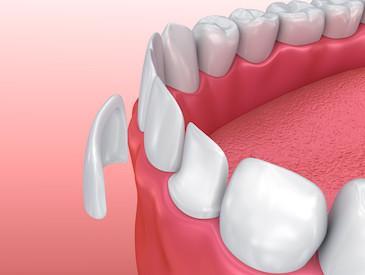 Veneers | Jonesboro AR Dentist