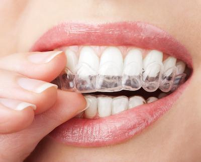 Invisalign in Jonesboro AR