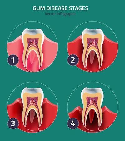 gum disease diagram jonesboro ar