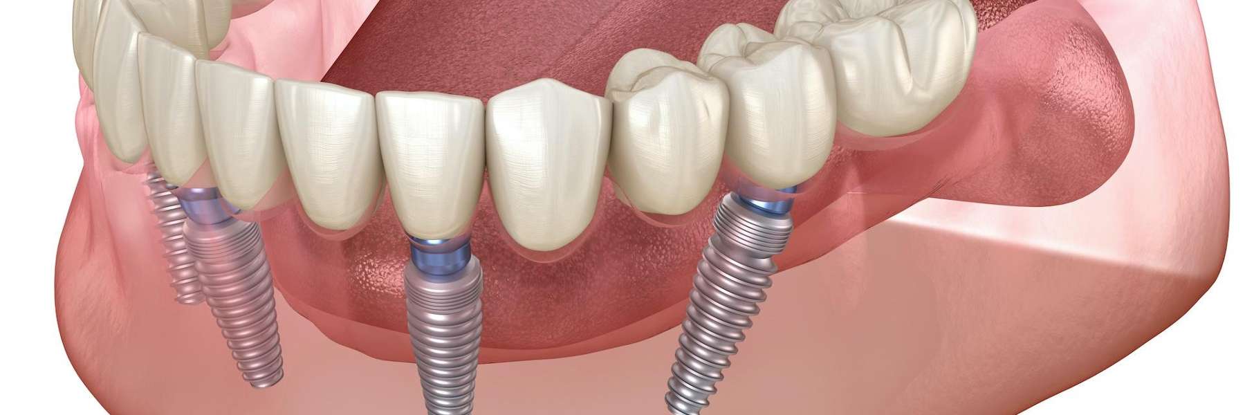 Dental implant screw diagram | dental implants Jonesboro