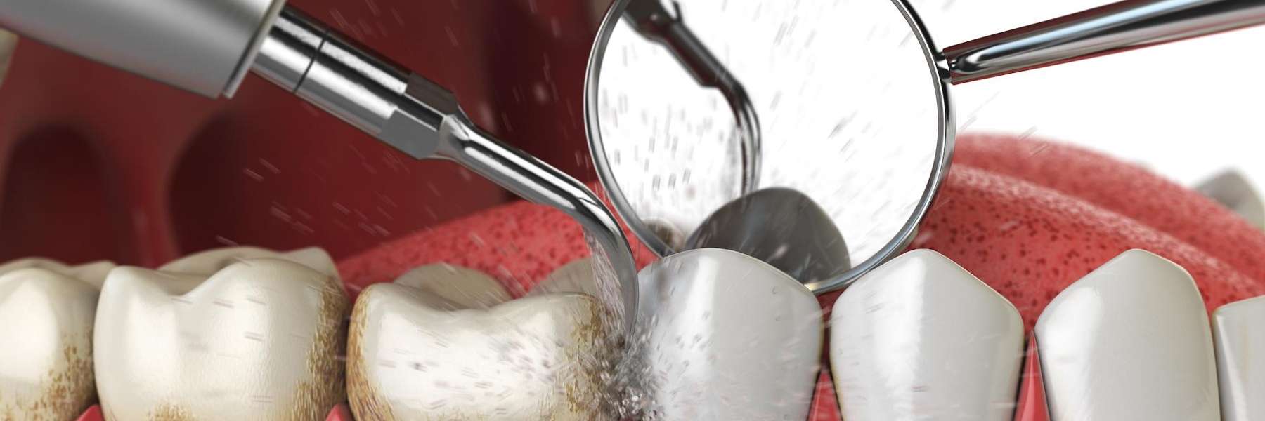 An illustration of a dental cleaning