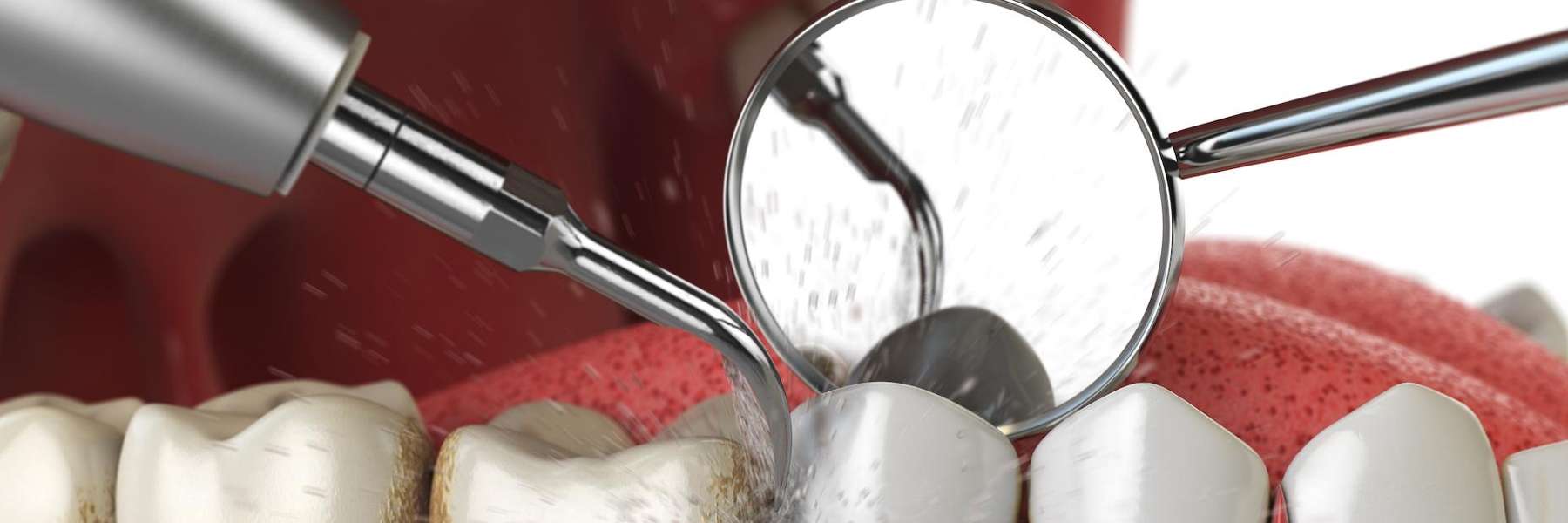 A dental cleaning diagram | Jonesboro dentist