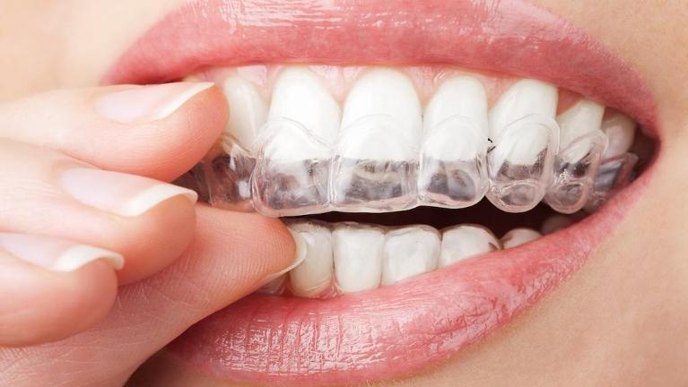woman putting in invisalign | Jonesboro Dentist