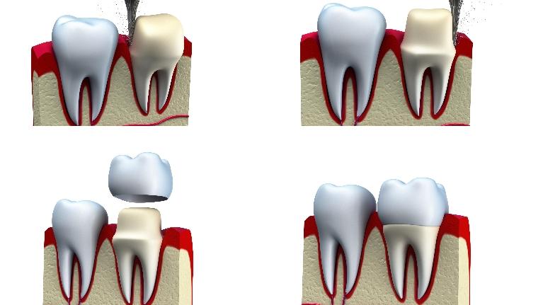 Crowns & Veneers in Jonesboro AR, Dr. Anthon Bartels, DDS