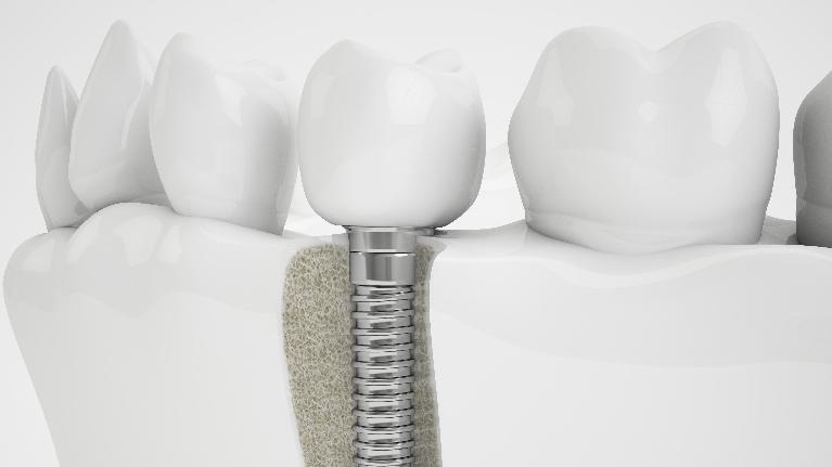 Dental Implants in Jonesboro AR, Dr. Anthony Bartels, DDS