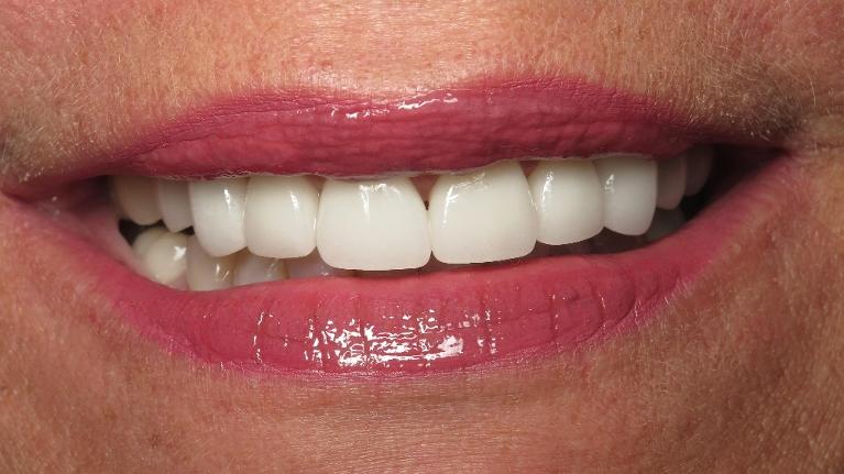 New Teeth | Jonesboro Cosmetic Dentist