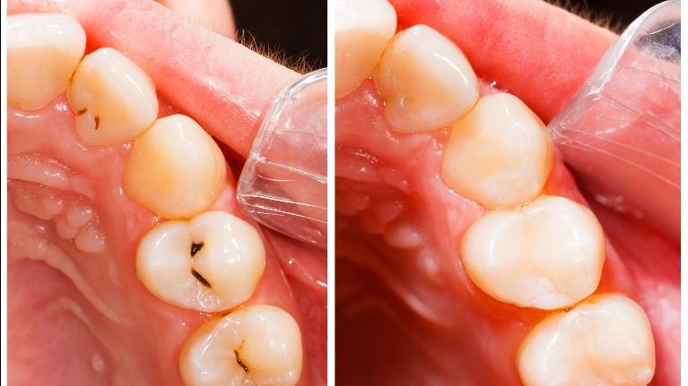 Tooth Colored Fillings in Jonesboro AR, Dr. Anthony Bartels, DDS