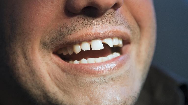 Dental Emergency in Jonesboro AR, Dr. Anthony Bartels, DDS