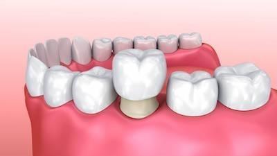 Dental crowns diagram