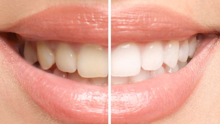 Teeth before and after professional teeth whitening