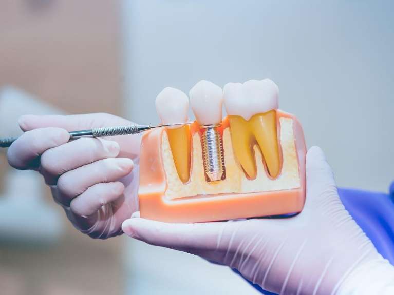 A dental implant model | dental implants Jonesboro