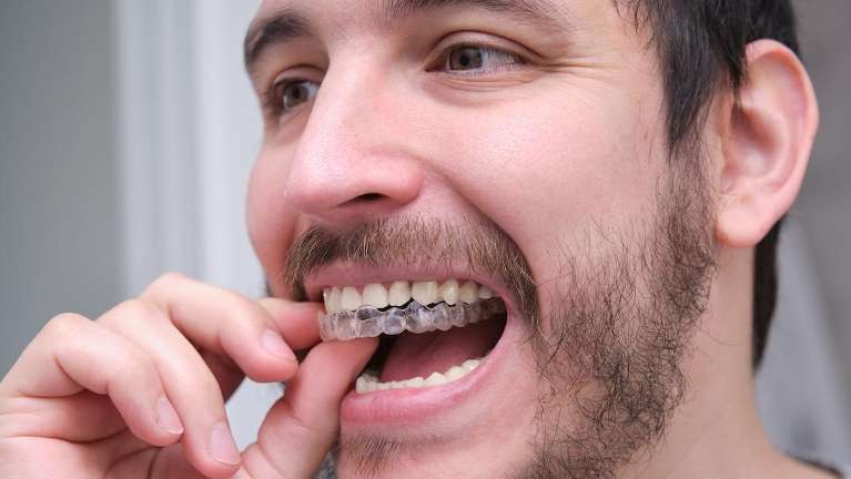 A man putting in his Invisalign tray