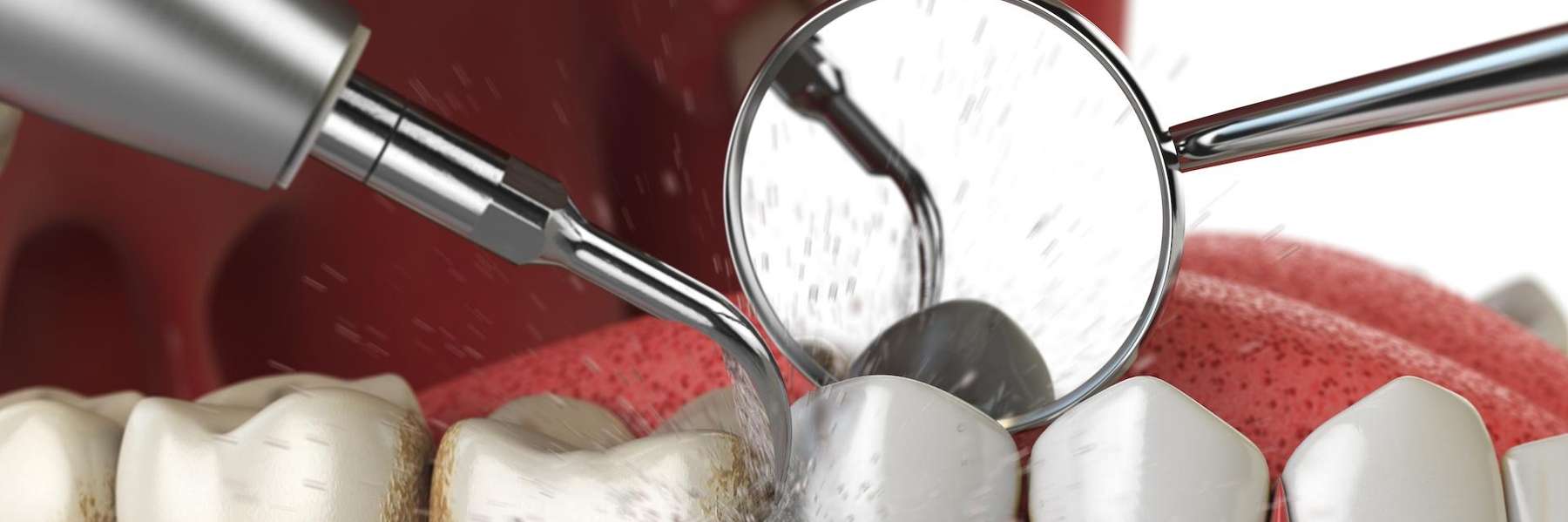 An illustration of a dental cleaning