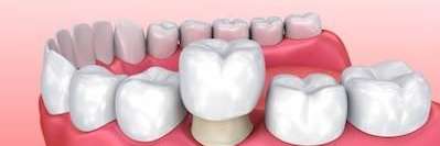 Diagram of a dental crown | dentist Jonesboro, AR
