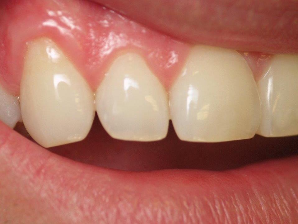 Before dental bonding | Jonesboro dentist