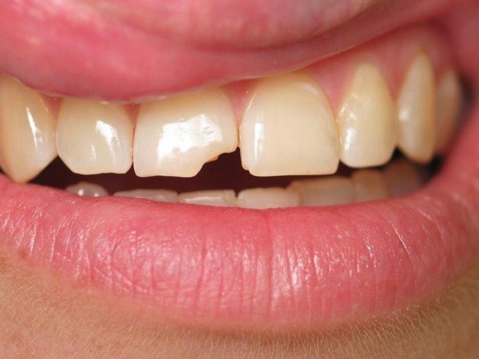 Patient before veneers | Jonesboro AR
