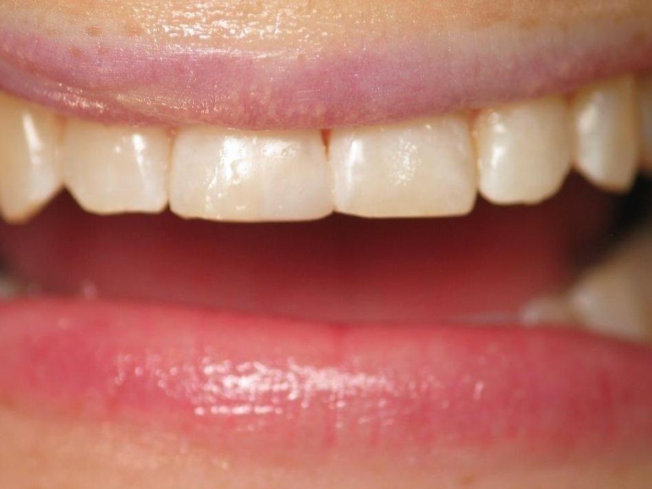 Patient after veneers | Jonesboro AR
