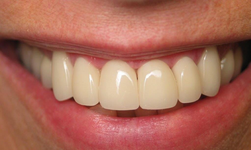 Patient teeth after veneers and crowns