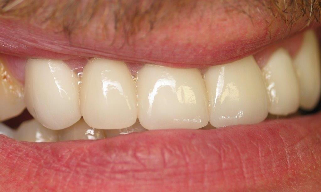 dentist with new crowns in jonesboro ar