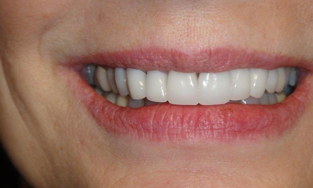 Patient after receiving new crowns
