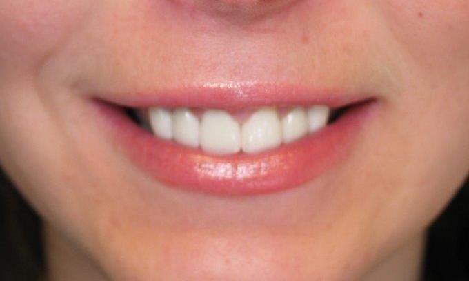 Patient smile after receiving veneers