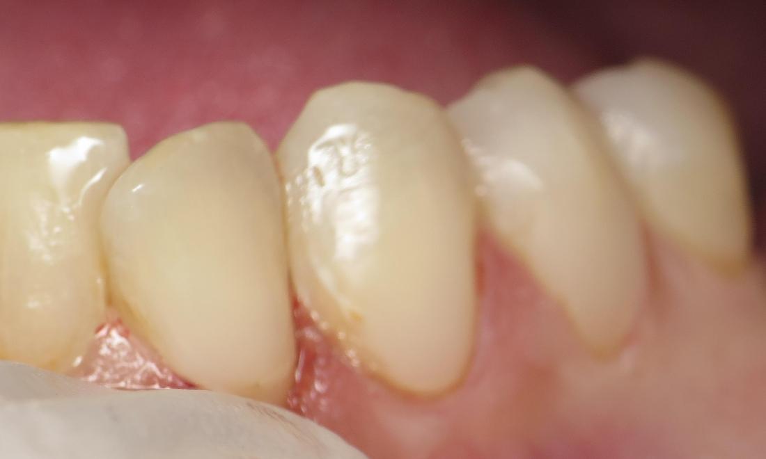 Patient with fixed tooth after bonding at Bartels Family Dentistry