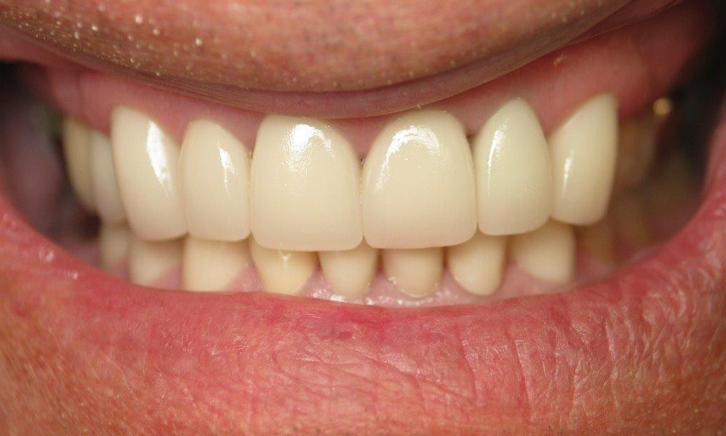 Patient smile after receiving veneers at Bartels Family Dentistry