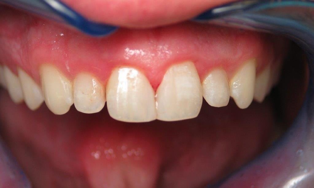 Patient after receiving composite bonding