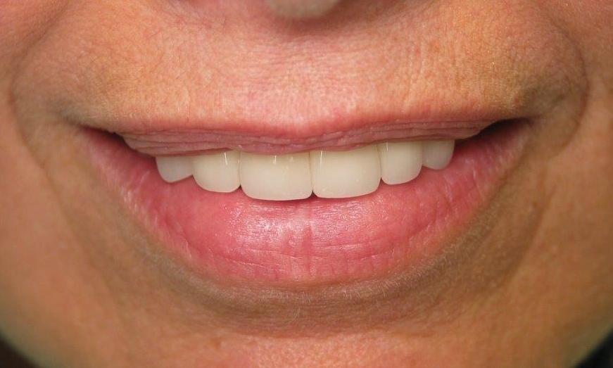 patient teeth after receiving veneers and crowns
