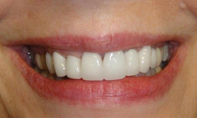 Patient teeth after receiving new crowns at Bartels Family Dentistry