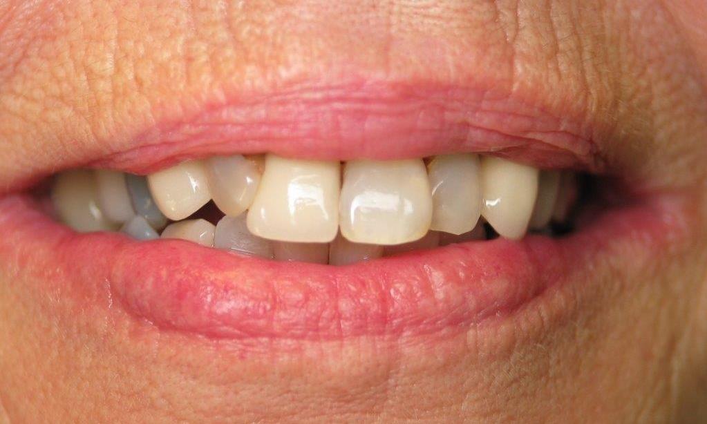 woman before porcelain crowns in jonesboro ar