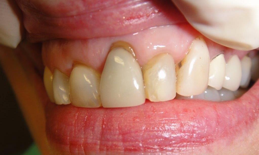 Patient with uneven gums and discoloration