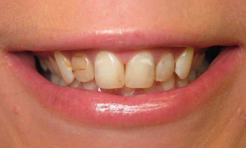 Stained teeth before veneers