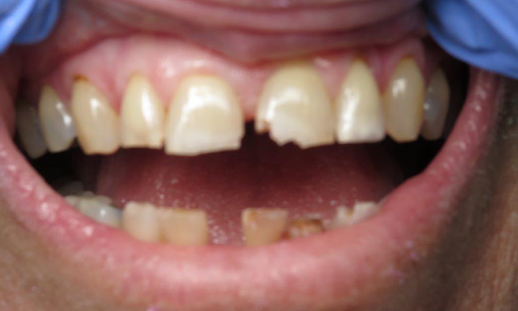 Patient in need of dental crowns in jonesboro ar