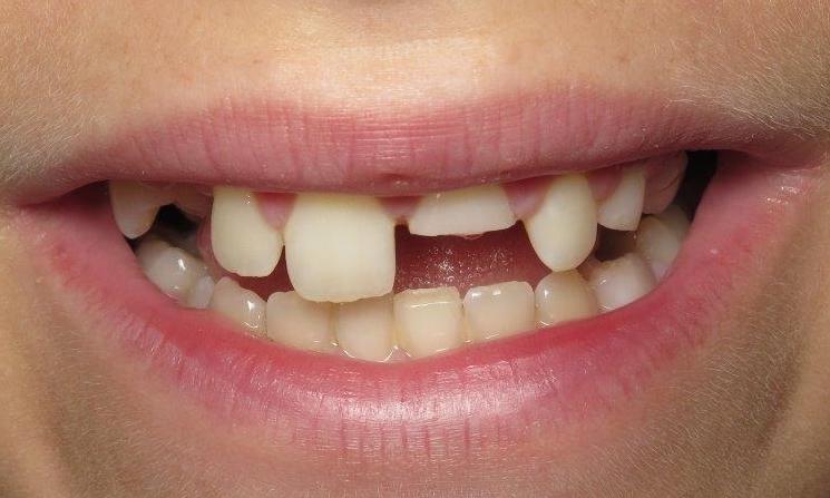 Child with a broken tooth