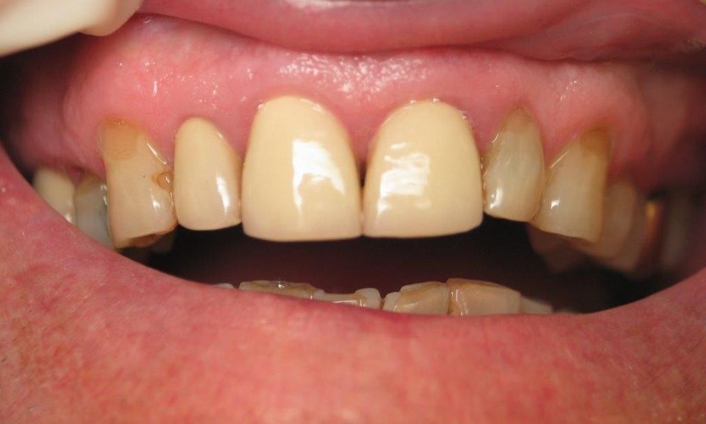 Patient with discolored teeth before veneers