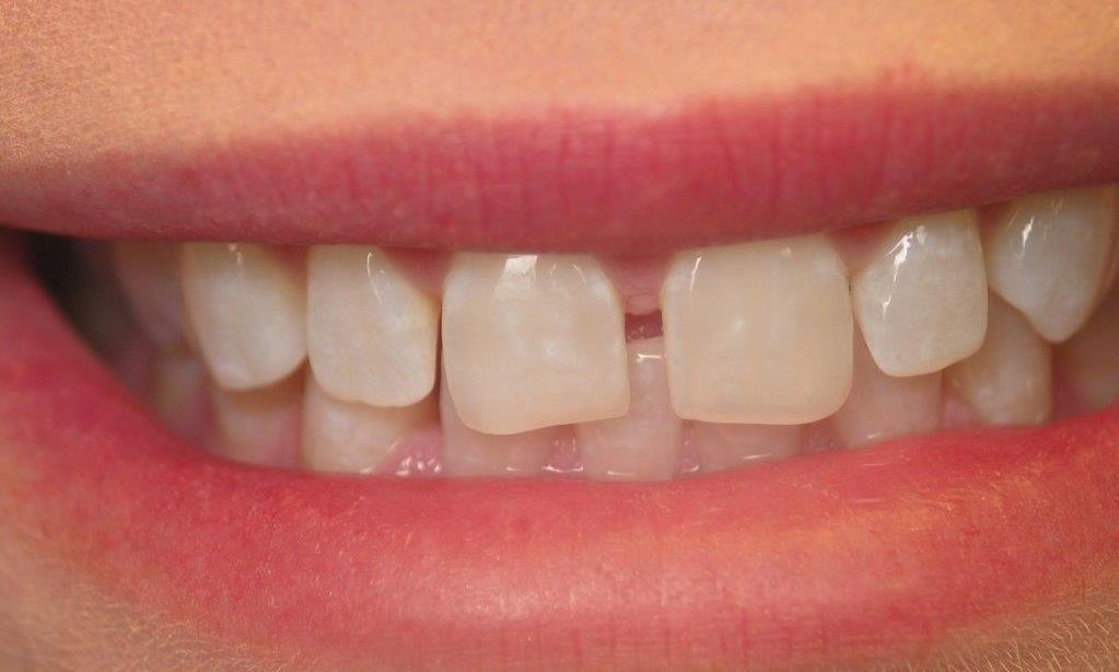 Patient with a spacing issue before bonding