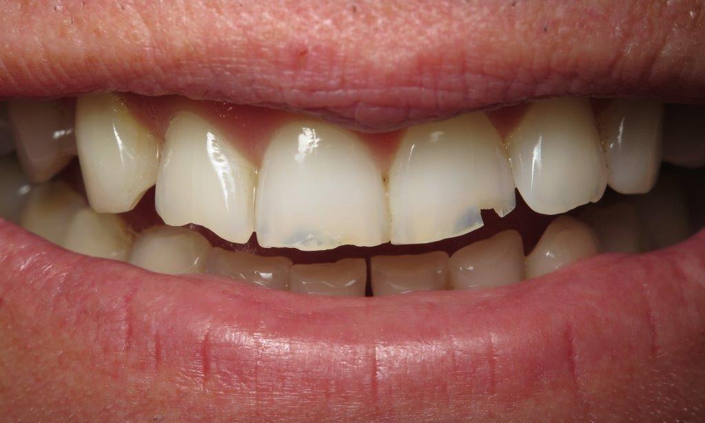 Patient Before Crowns | Jonesboro Dentist