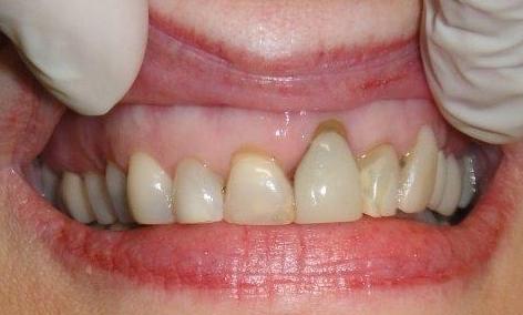 Patient teeth before new crowns