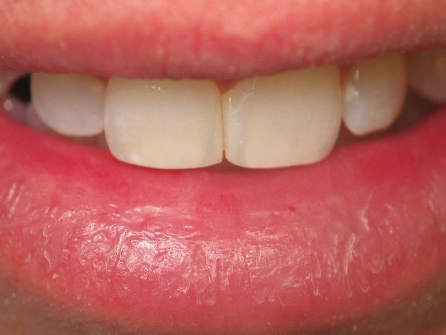 after dental bonding | jonesboro ar cosmetic dentist