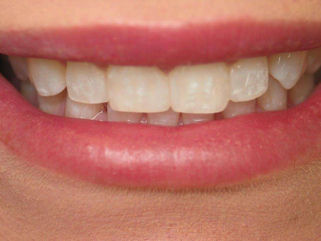 Cosmetic Dentistry in Jonesboro- After Photo