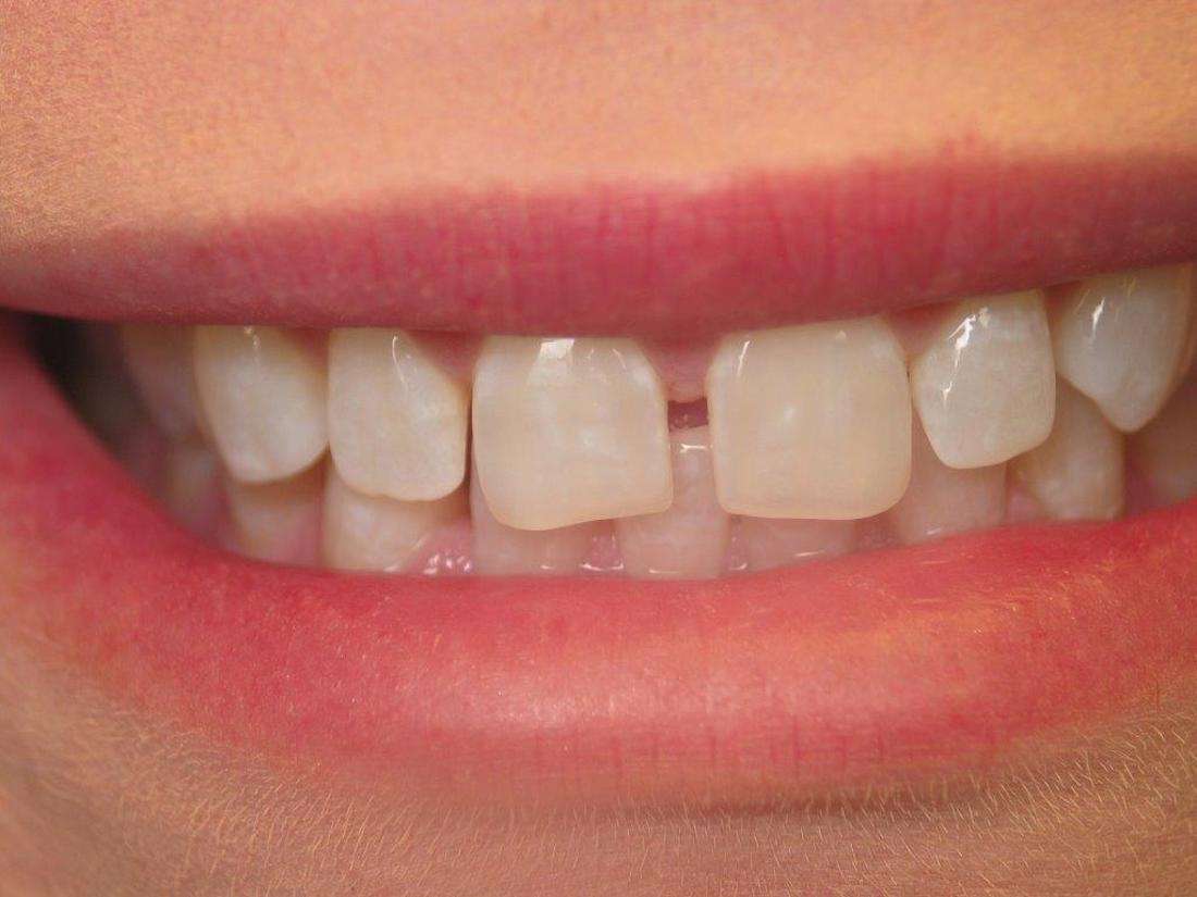 Cosmetic Dentistry in Jonesboro- Before Photo