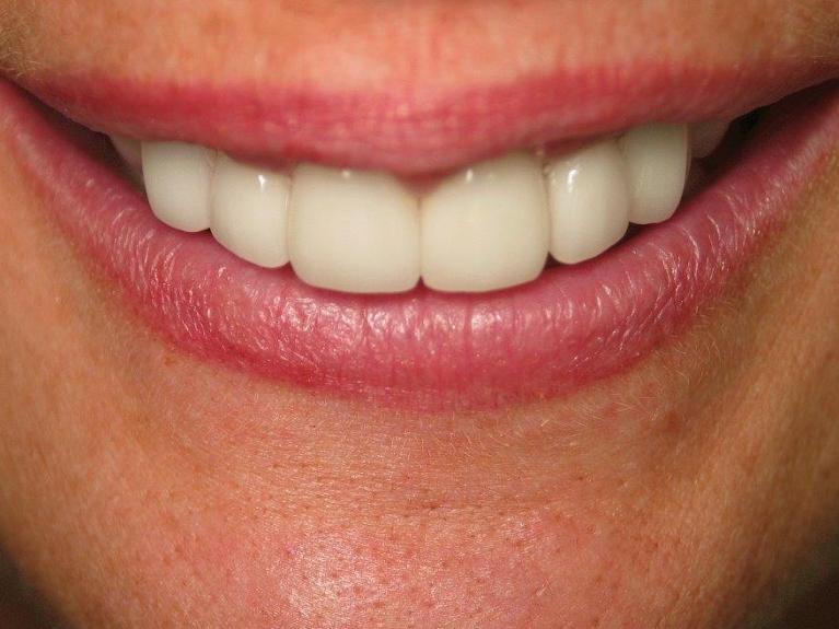 Veneers-and-Crowns-in-Jonesboro-Arkansas-After-Image