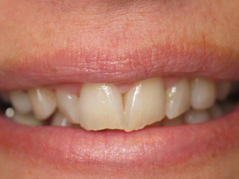 Veneers-and-Crowns-in-Jonesboro-Arkansas-Before-Image