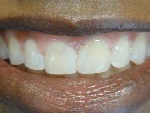 Bonding-and-Bleaching-After-Image