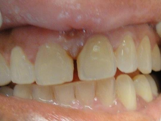 Bonding-and-Bleaching-Before-Image