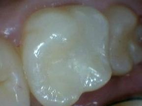 Tooth-Colored-Fillings-in-Jonesboro-AR-After-Image