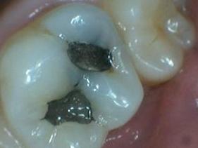 Tooth-Colored-Fillings-in-Jonesboro-AR-Before-Image